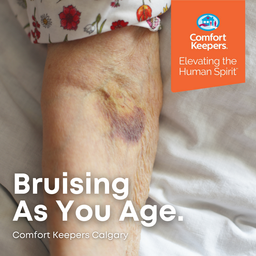 Bruising As You Age