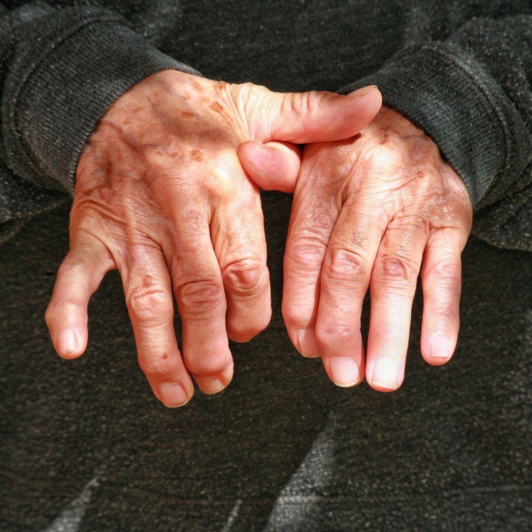 Photo of a pair of hands with the affects of osteoporosis